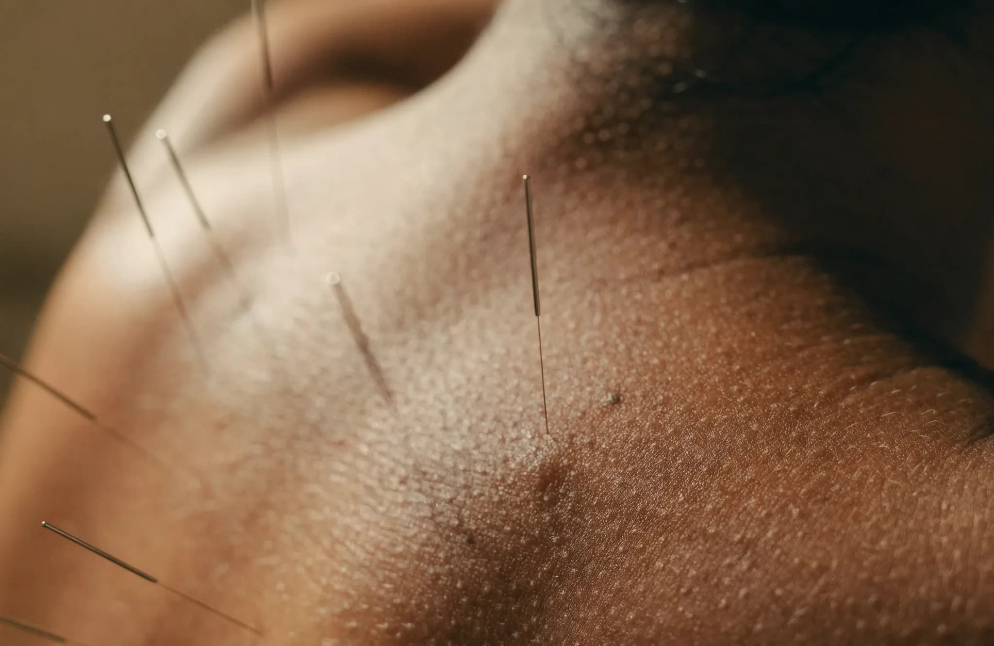 Close-up of fine acupuncture needles placed along a person's shoulder